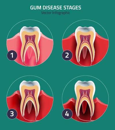 graph showing gum disease stages | dentist bloomington indiana